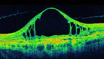 Lung Cancer Radiomics - Tumor Region Segmentation