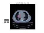 Classification of Diseases from Retinal OCT Scan